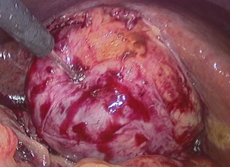 Admin/uploads/11_06_201810_24Gangrenous Gallbladder.png